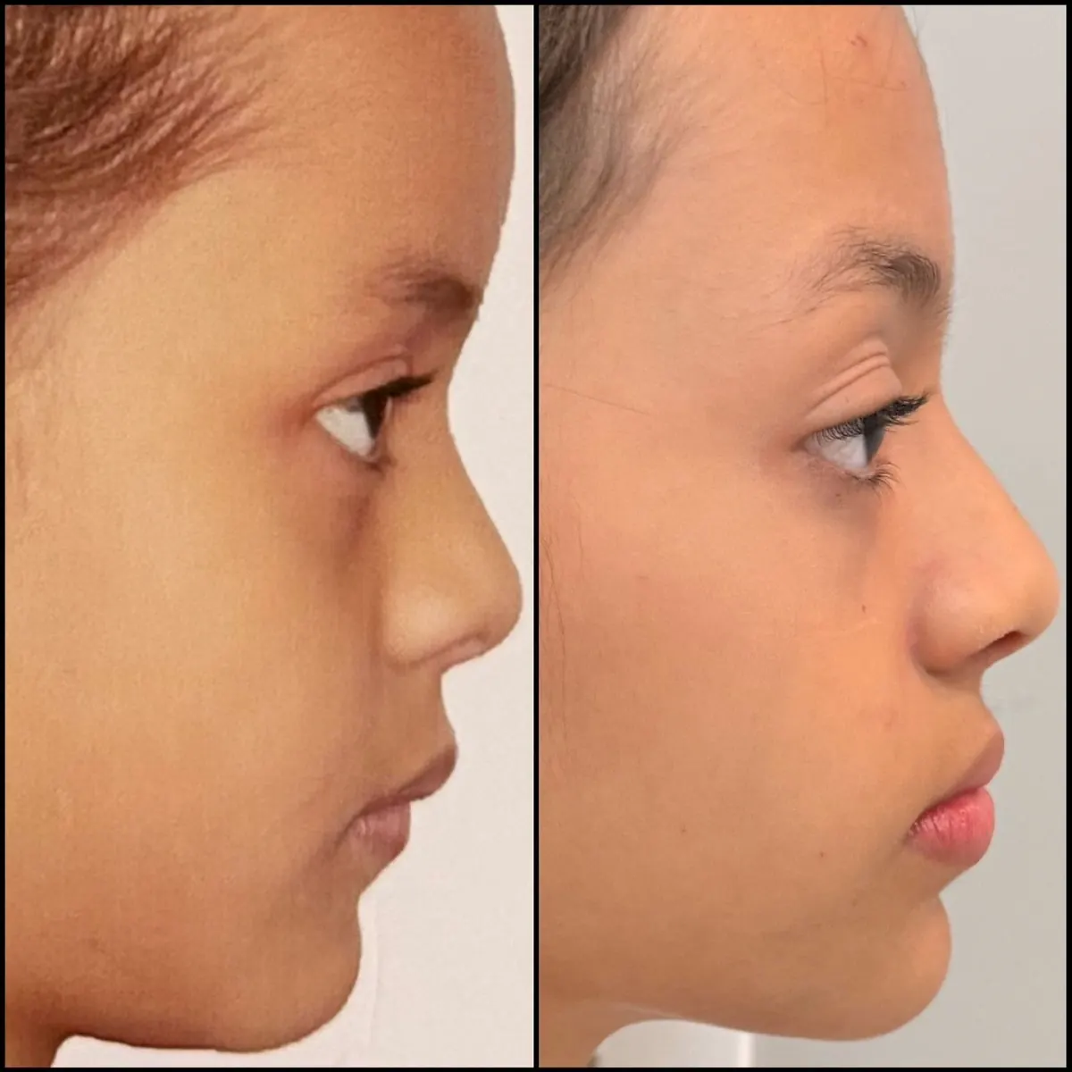 Perfil facial de uma menina antes, à esquerda, e depois, à direita, do acompanhamento em ortopedia funcional dos maxilares